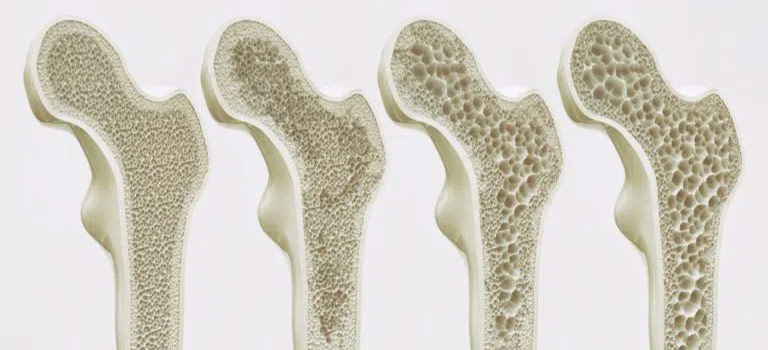 bone densitometry - سنجش تراکم استخوان - مرکز سنجش تراکم استخوان - سنجش تراکم استخوان قم - سنجش تراکم استخوان طب آزما - گروه تشخیصی درمانی فرجاد - فرجاد - فرجاد قم